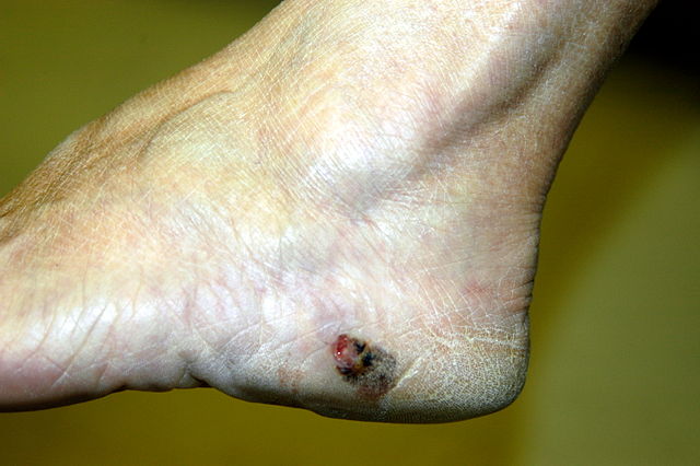 Malignant Melanoma on left foot